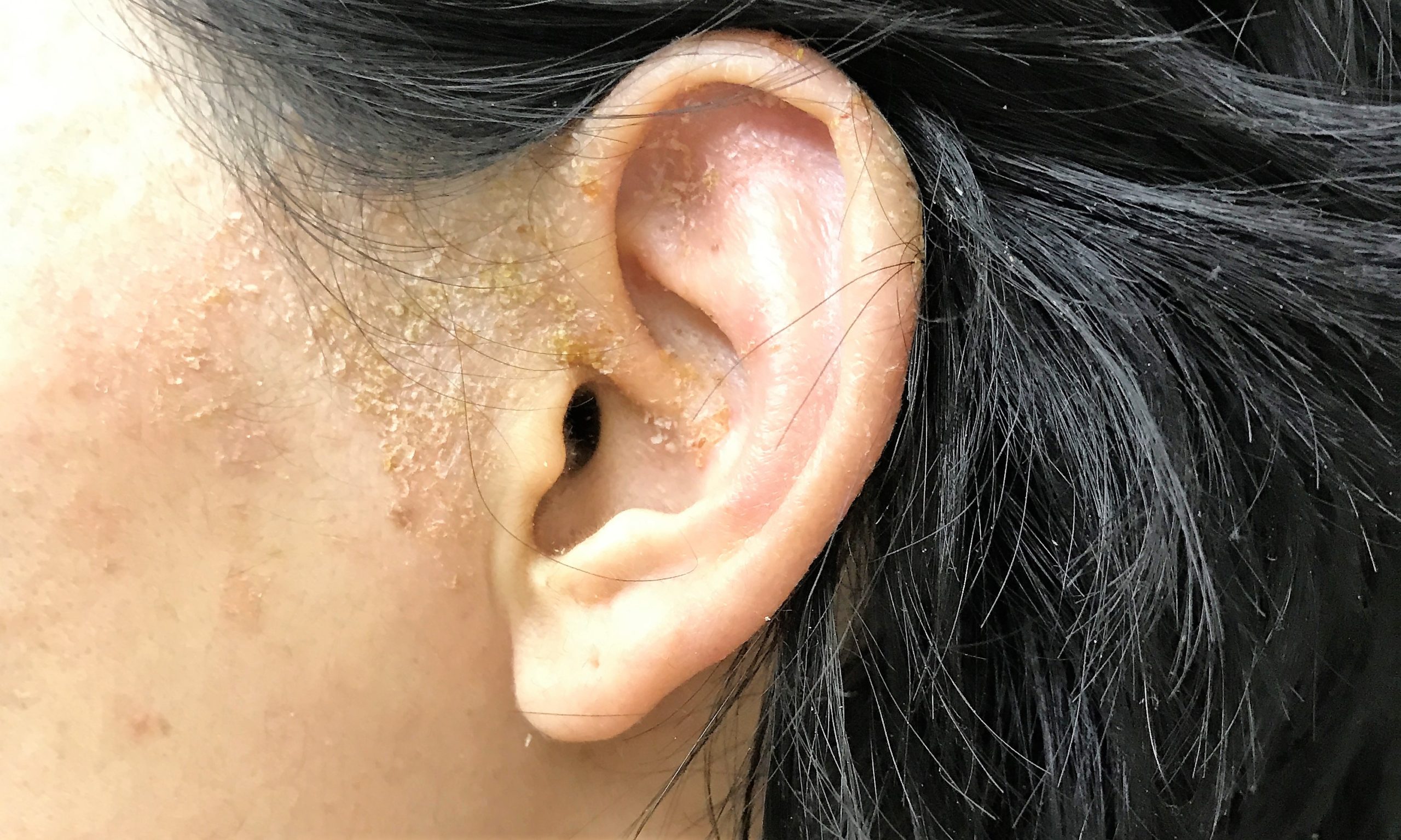 耳 の 中 湿疹